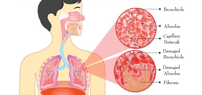 Fibrosis pulmonary causes idiopathic cough newlifeticket ipf diagnosis healthjade