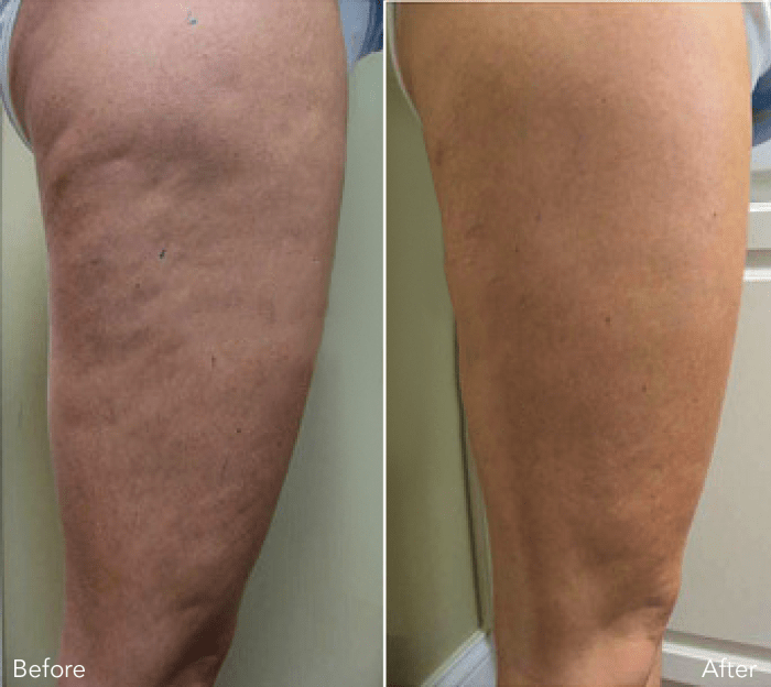 Biotyspa reviews before and after